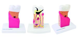 Modell der Zahnkrankheiten