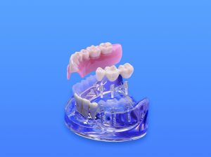 Unterkiefer-Implantatmodell 1