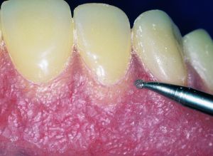 Stippling Instrumente 1