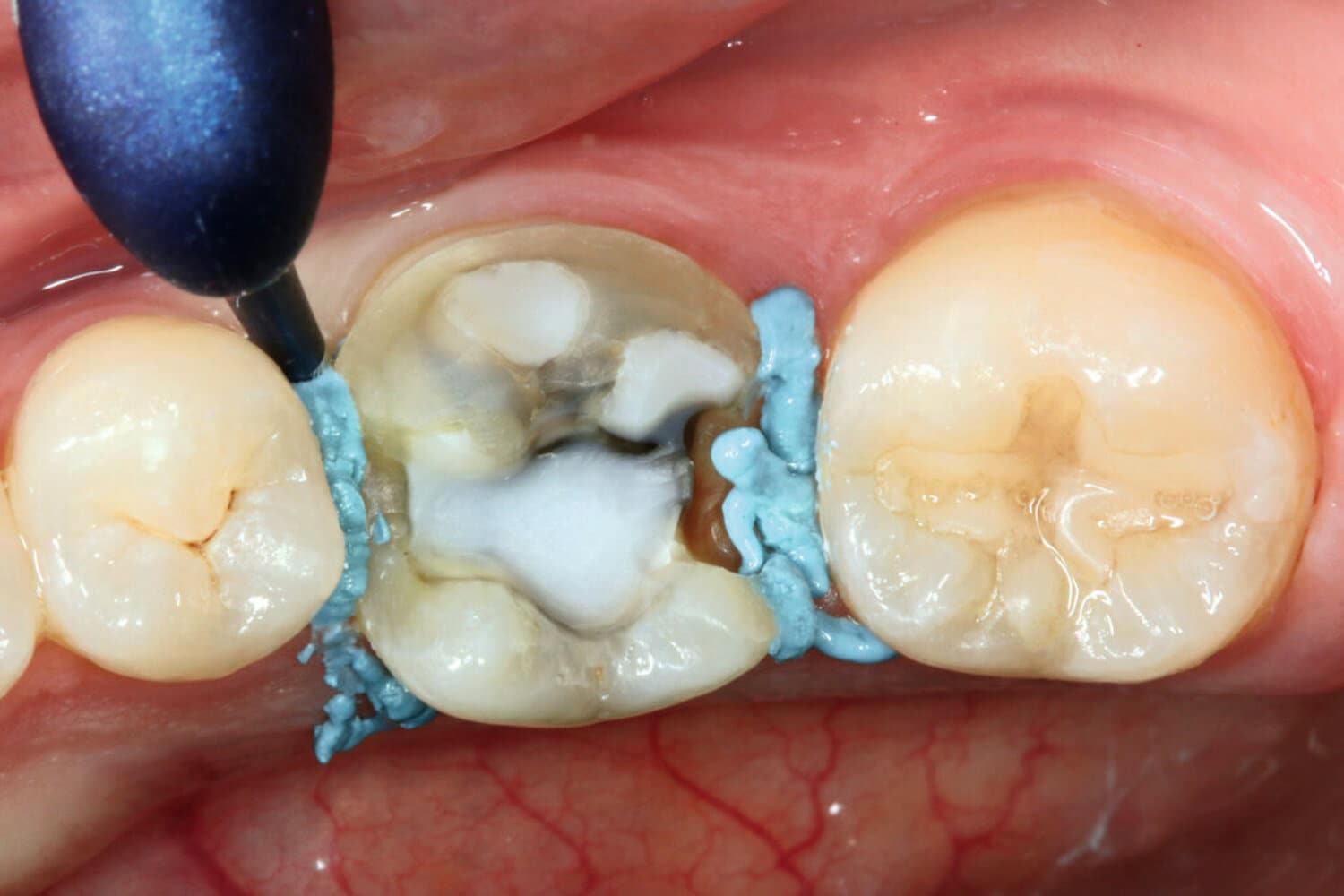 clinical-case-image-of-astringent-retraction-paste-being-applied-to-tooth