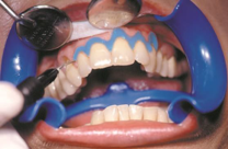 Bild I - Vorbereitung Bleaching-Behandlung mit ManiShine