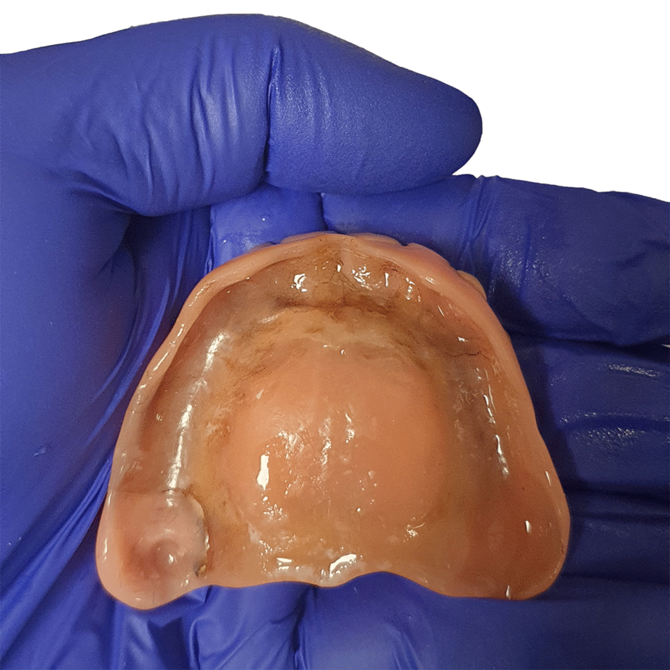 Effiziente Prothesenreinigung mit SYMPRO - Anwendung - Nachher - Bild 2