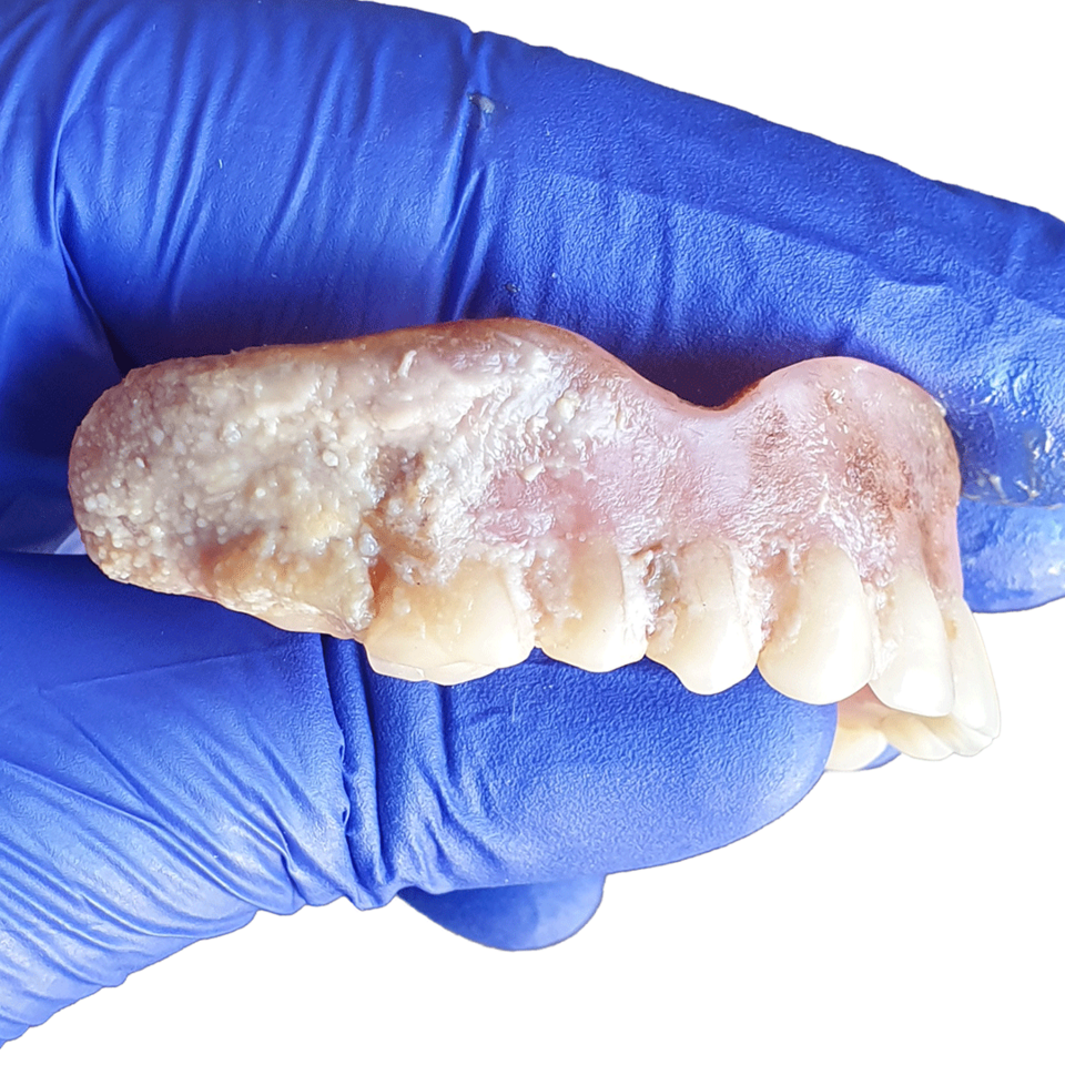 Effiziente Prothesenreinigung mit SYMPRO - Anwendung - Vorher - Bild 1