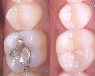Abbildung Austausch einer Amalgamversorgung durch eine Füllung mit 3M Komposit.