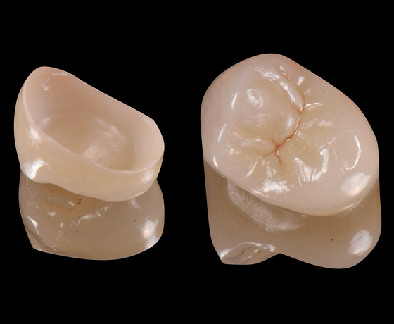 Monolithische Krone aus Zirkoniumoxid in zwei unterschiedlichen Ansichten.
