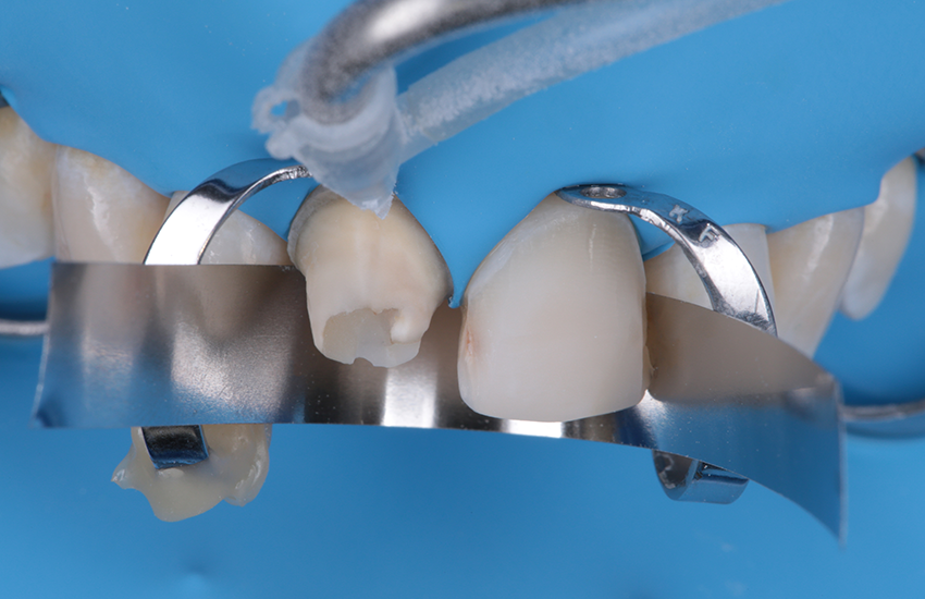 Abbildung 9: Vorbehandlung des Kompositaufbaus durch Sandstrahlen mit 30 µm Aluminiumoxid.