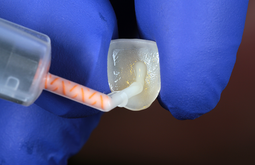 Auftrag von 3M™ RelyX™ Universal Befestigungskomposit.