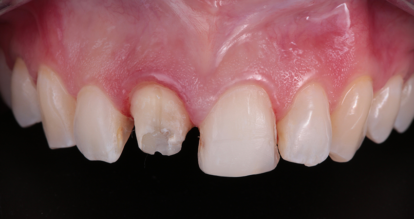 Gereinigte Veneer- und Kronenpräparationen an den Zähnen 11 und 12 bereit für die Einprobe.