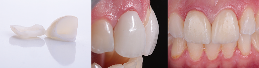 Einprobe eines Veneers und einer Krone an den Zähnen 11 und 12.