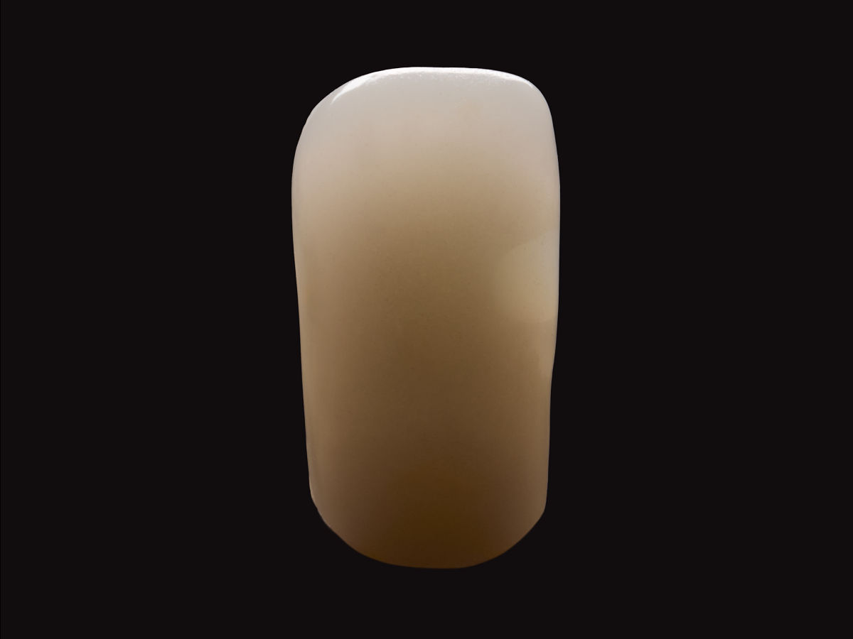 Abbildung 4 Präparation Nachher mit Material eines anderen Herstellers mit Blocker - Spuren zu erkennen