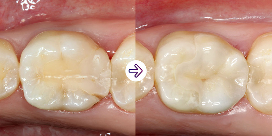 Solv_Page_Impregum_Penta_Super_Quick_II_290px