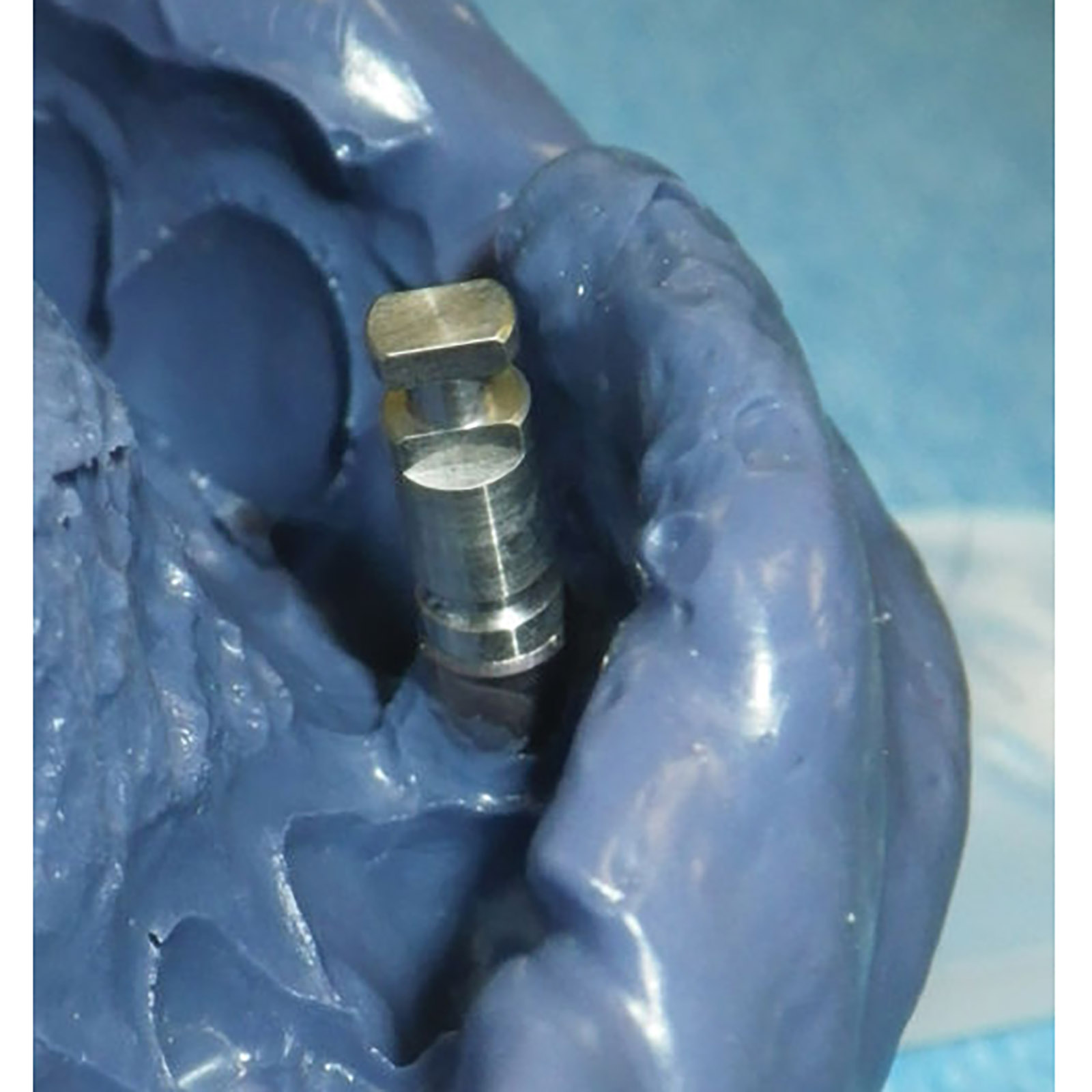 Klinischer Fallbeispiel lesen >>Predictable Implant Impressions Using 3M™ Impregum™ Soft Quick Step Polyether Impression Material