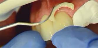 3m-relyx-universal-resin-cement-easy-excess-clean-up_II