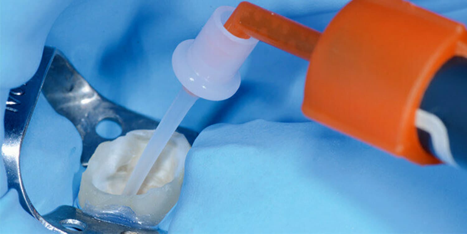 pdp-case-study-image-of-cement-being-applied-to-a-root-canal