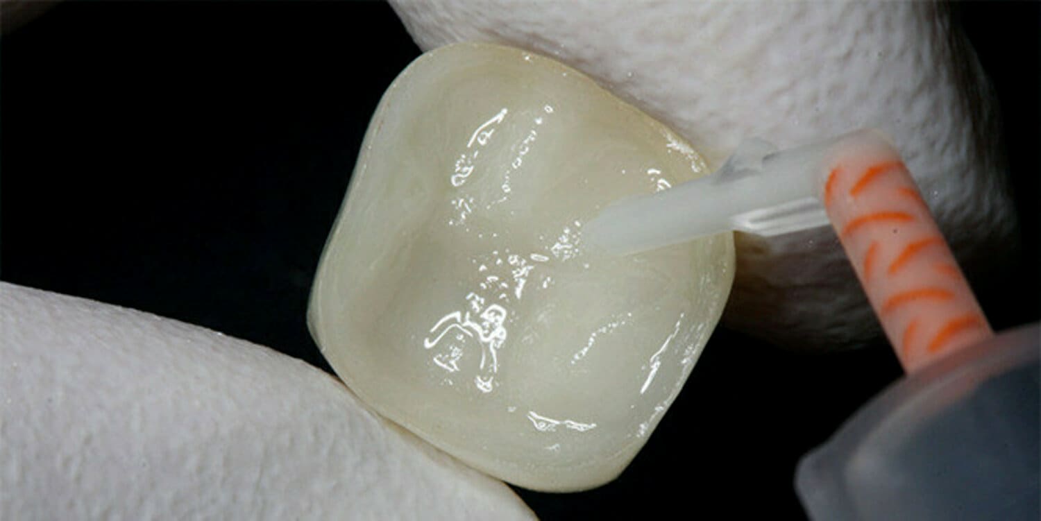 pdp-case-study-image-of-cement-being-applied-to-dental-onlay