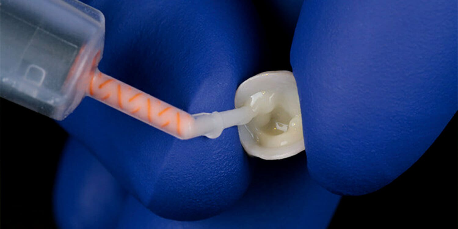 pdp-case-study-image-of-cement-being-applied-to-veneer